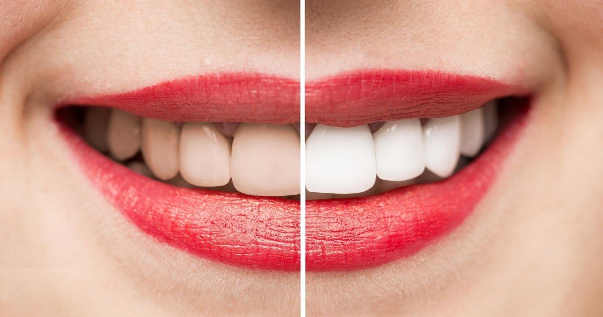 Nos Astuces Naturelles Pour Avoir Des Dents Plus Blanches